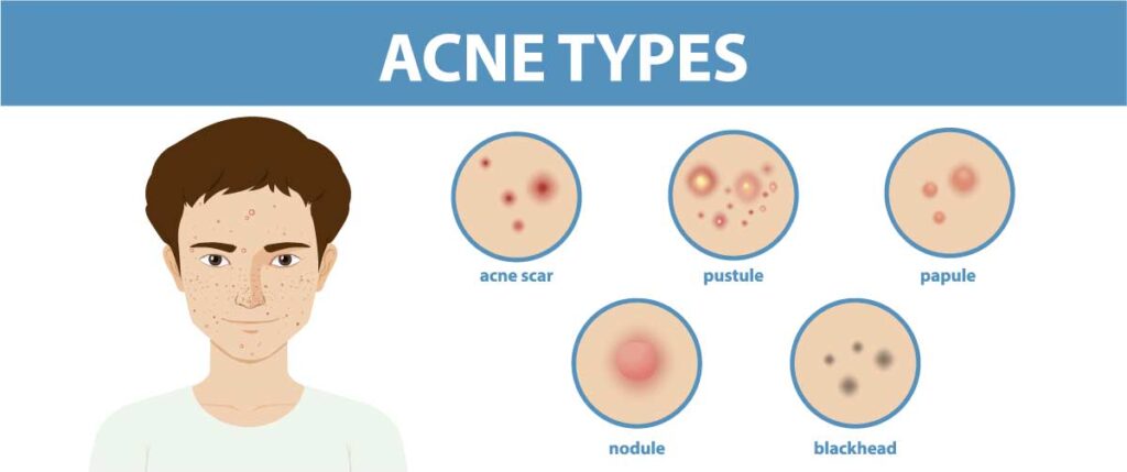 fungal-acne-types