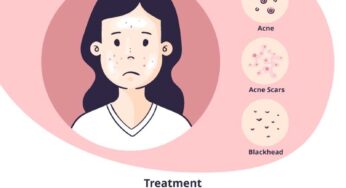 The Ultimate Guide: How to Get Rid of Fungal Acne and Treat It Naturally