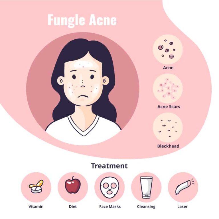 fungal-acne-looks